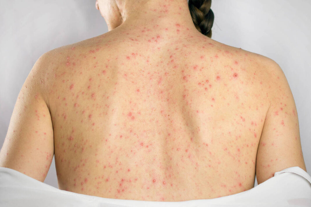 Deputada faz projeto para que SUS dar vacina da herpes – 03/02/2026 – Painel