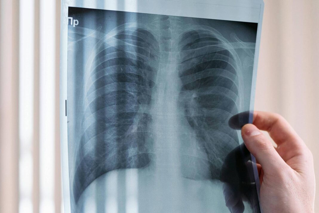 Vacina contra o câncer de pulmão entrará em fase de testes – 25/11/2025 – Equilíbrio e Saúde