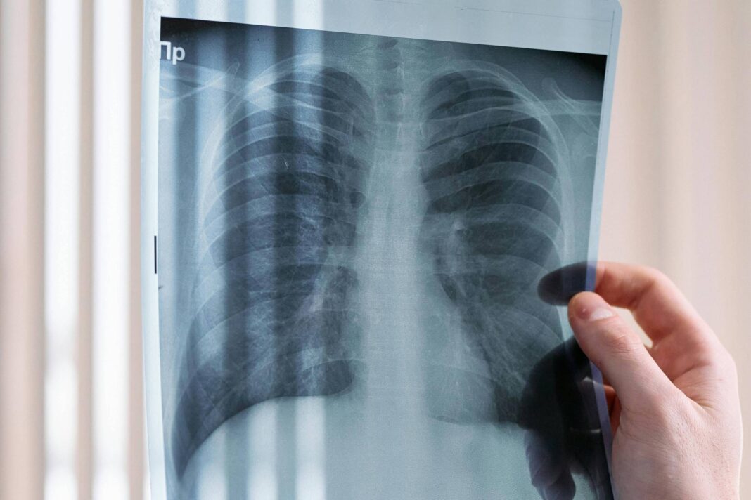 Obesidade e inflamação aceleram envelhecimento pulmonar – 20/02/2026 – Equilíbrio e Saúde