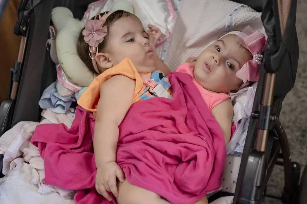 Morre segunda gêmea siamesa separada da irmã, em Goiânia – 26/12/2025 – Equilíbrio e Saúde