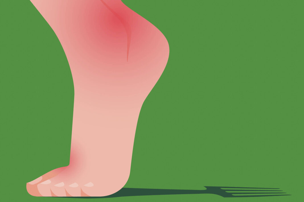 O que é gota e por que está se tornando mais comum – 30/12/2025 – Equilíbrio