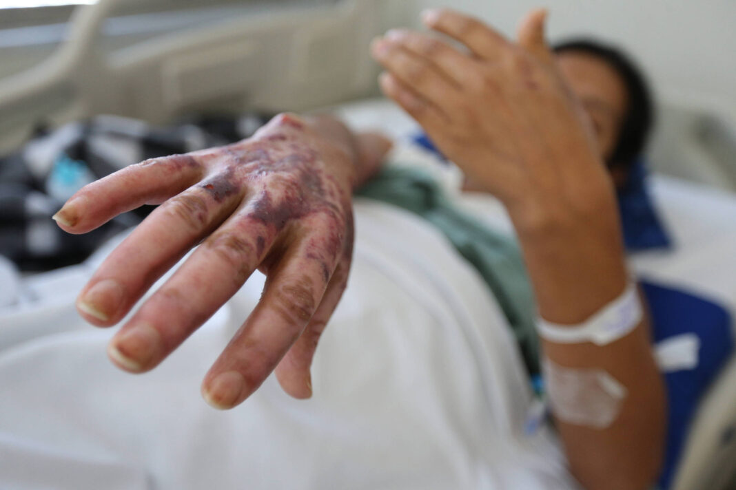 Saiba quais são os 4 tipos de queimadura – 28/01/2026 – Tv Folha