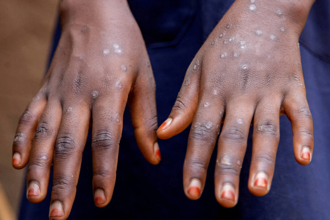 Mpox: SP registra segundo caso de variante agressiva – 13/01/2026 – Equilíbrio e Saúde