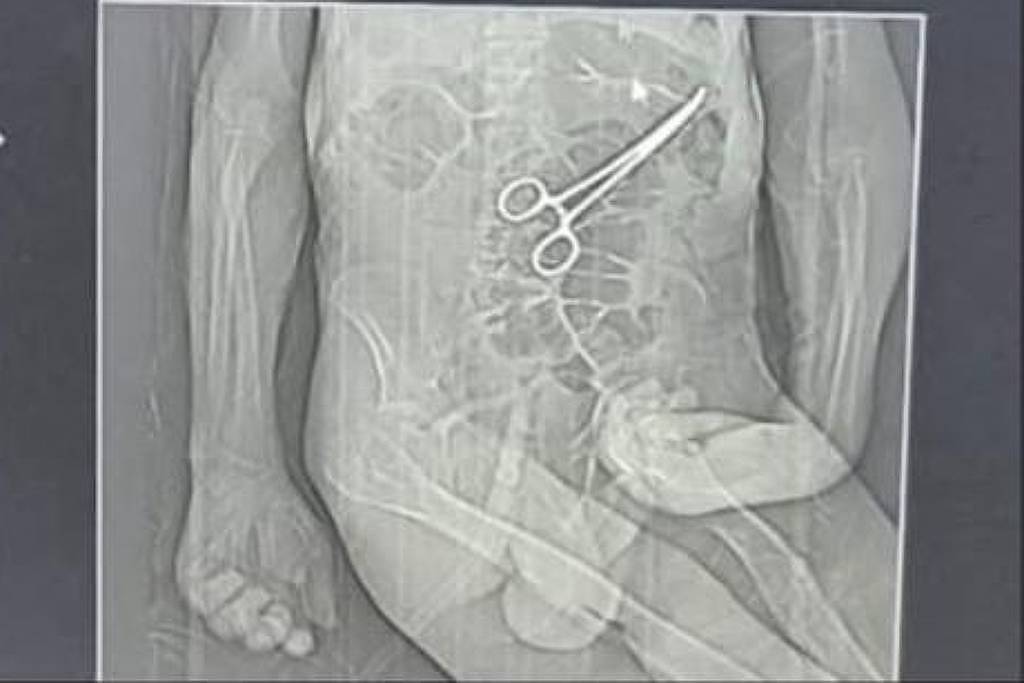 Hospital esquece pinça em corpo de idoso morto no Natal – 02/01/2026 – Equilíbrio e Saúde