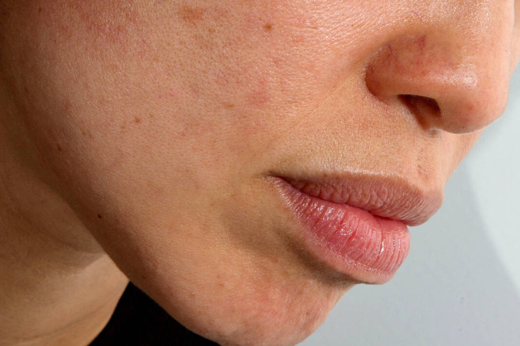 Meu rosto fica vermelho e corado; por que isso está piorando com a idade?